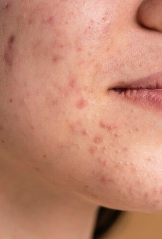 acne scar treatment cost