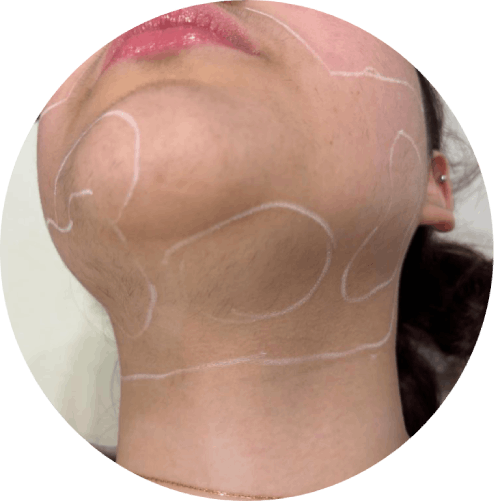 Facial hair removal treatment in gurgaon