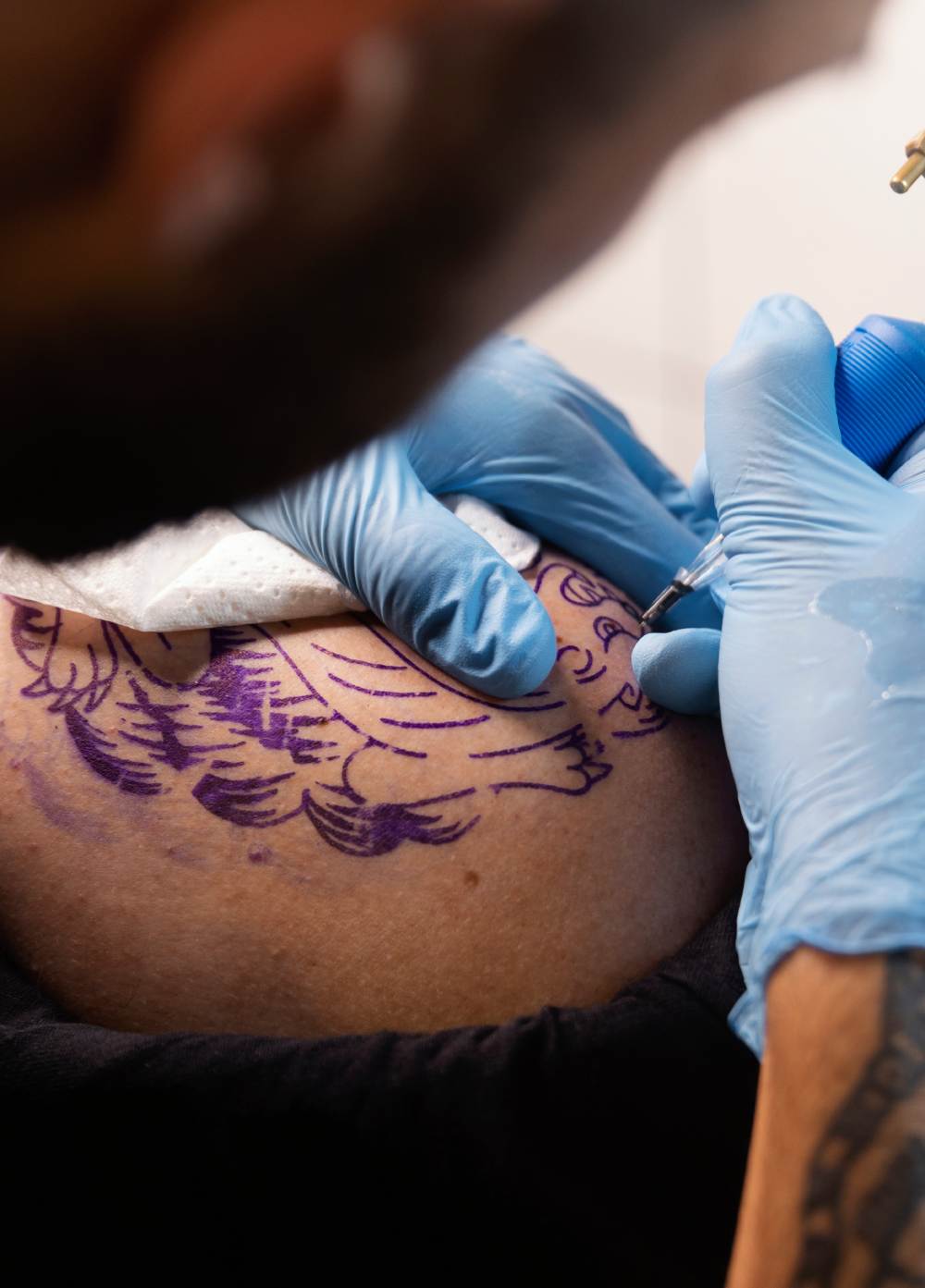 laser treatment for tattoo removal cost