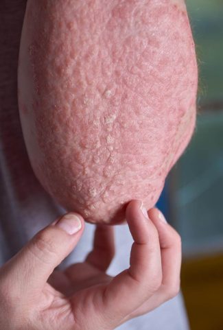 eczema treatment in gurgaon