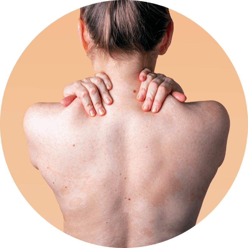 Best eczema treatment in gurgaon