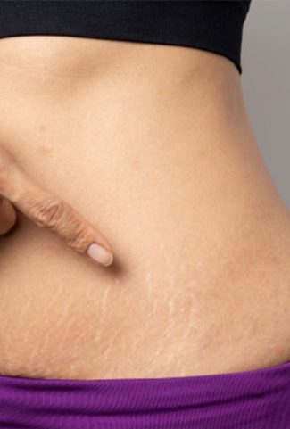 laser treatment for stretch marks