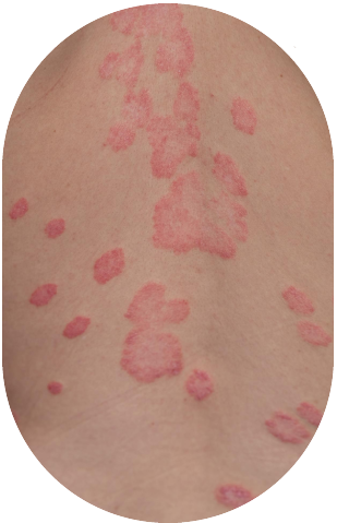 eczema treatment in gurgaon