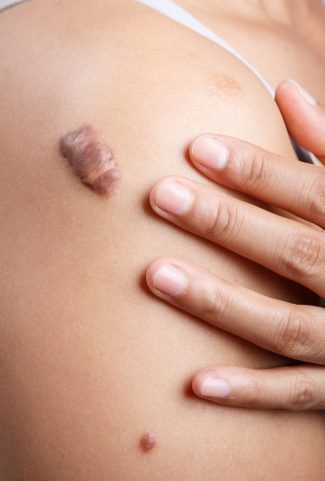 keloid treatment in gurgaon