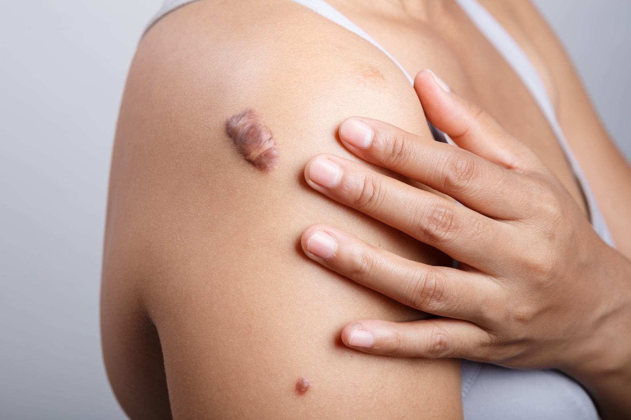 keloid treatment in gurgaon