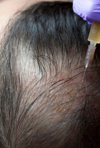 prp hair treatment in gurgaon