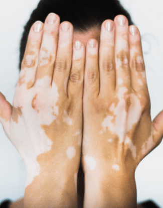 vitiligo treatment in gurgaon