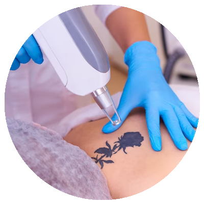 laser treatment for tattoo