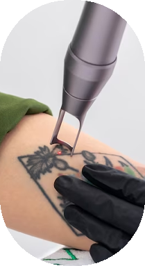 laser treatment for tattoo in Gurgaon