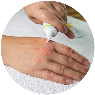 eczema treatment for hands in gurgaon