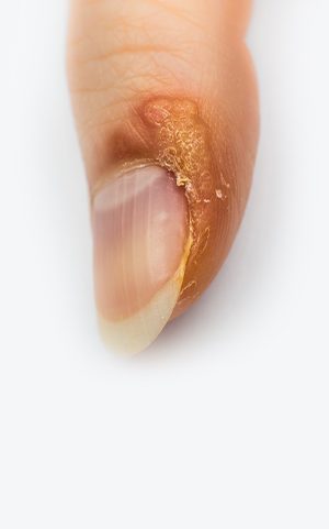 nail fungus treatment in gurgaon