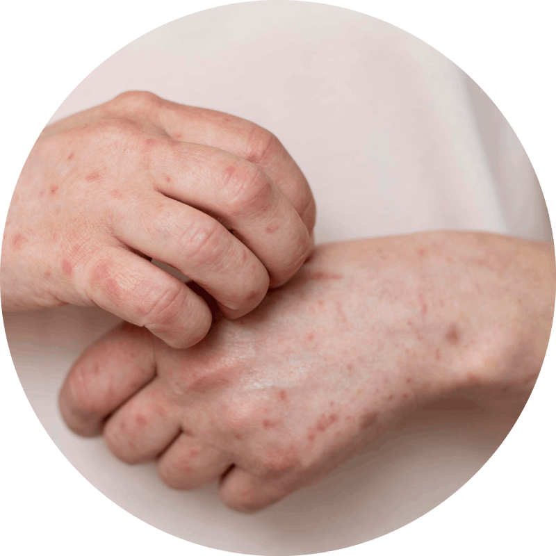 psoriasis treatment in gurgaon