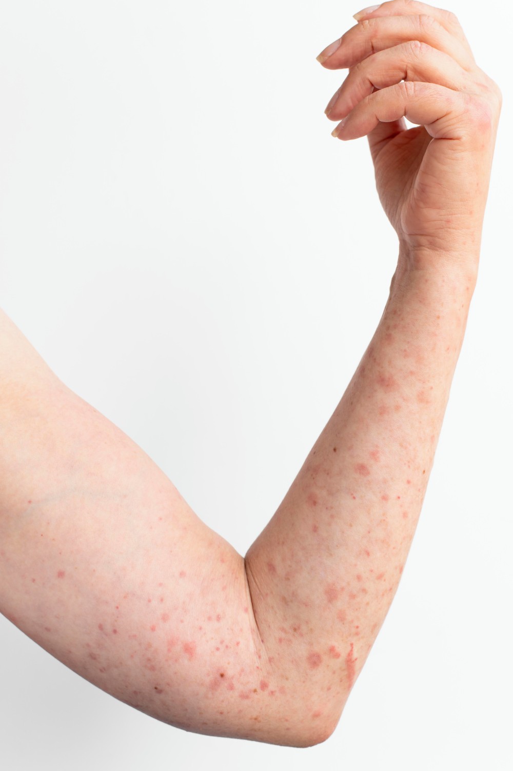 Best psoriasis treatment in gurgaon