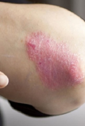 psoriasis treatment in gurgaon