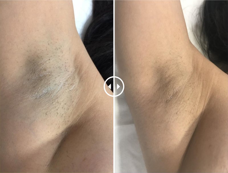LHR OF Underarm