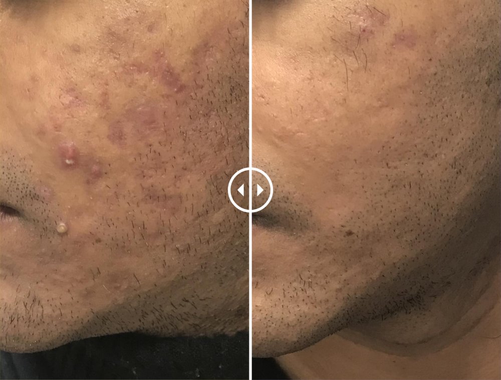 Acne Free face