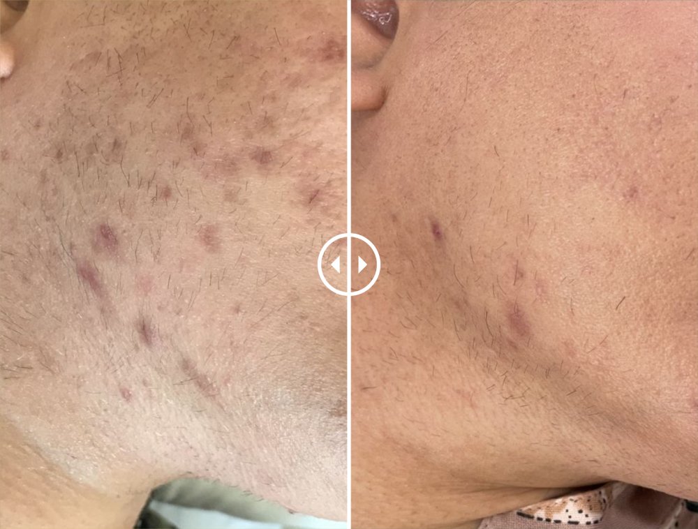 Acne & Spot Free face 2