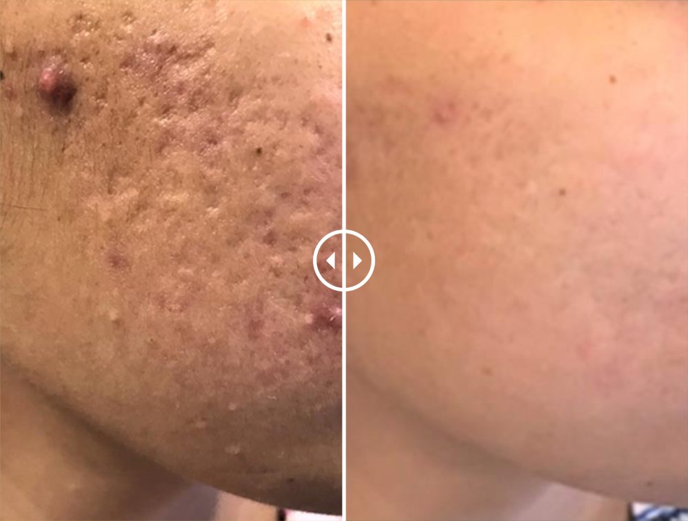 acne scar treatment in Gurgaon