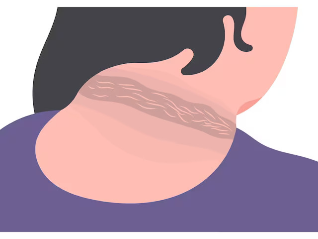 Combating Pre-Diabetic Pigmentation: Unveiling Treatment Options