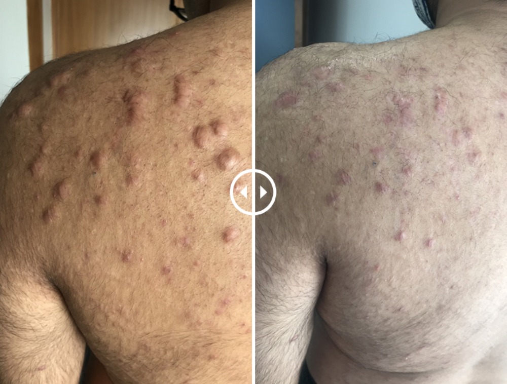 keloid treatment in gurgaon