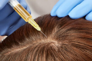 PRP for hair fall