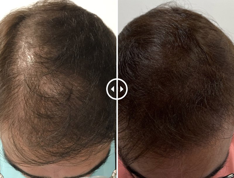 prp hair treatment in gurgaon