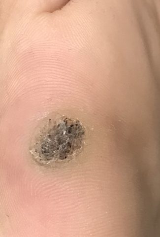 wart removal in gurgaon