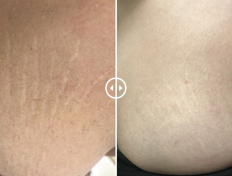 Stretch Marks before & after (2)