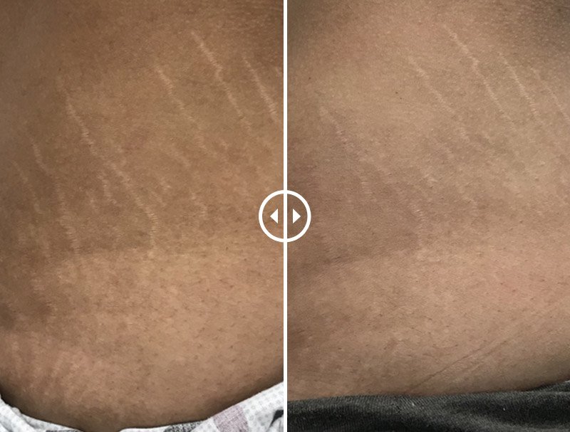 laser treatment for stretch marks