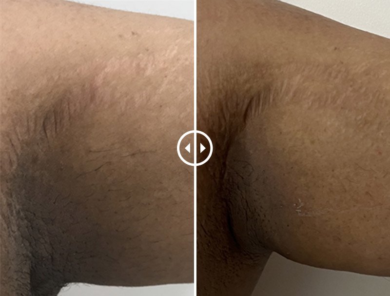 Stretch Marks before & after
