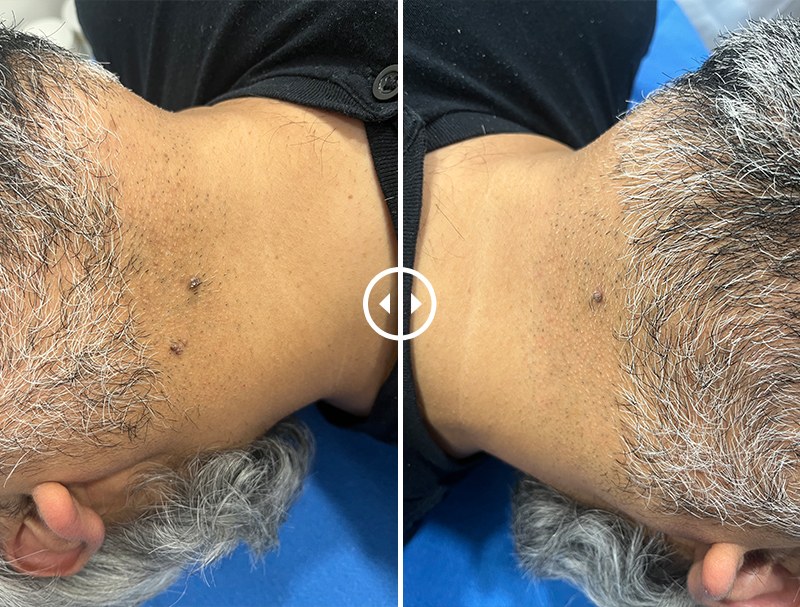 wart removal in gurgaon
