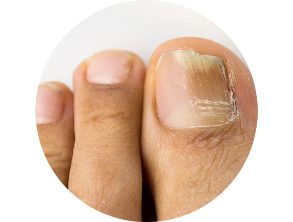 nail fungus treatment