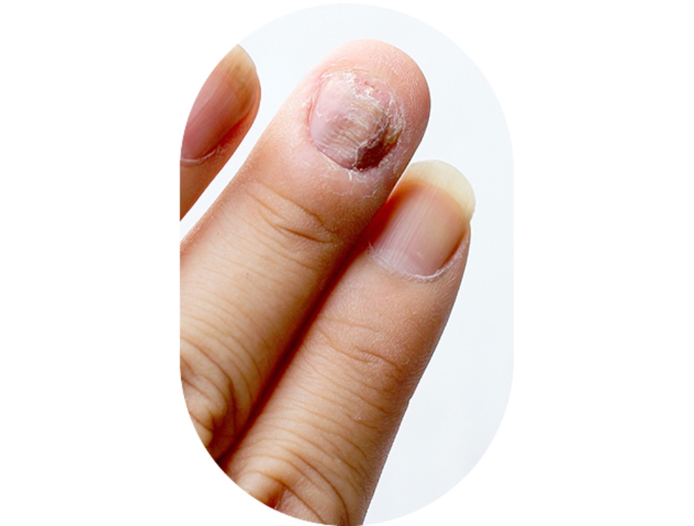 nailfungus2