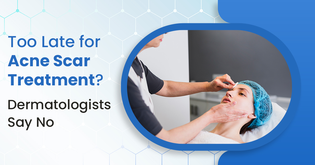 Too Late for Acne Scar Treatment? Dermatologists Say No